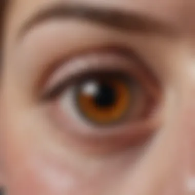 Clinical Features of Conjunctival Melanoma Clinical presentation of conjunctival melanoma
