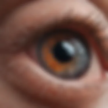 Microscopic Examination of Melanoma Conjunctival Microscopic view of conjunctival melanoma cells